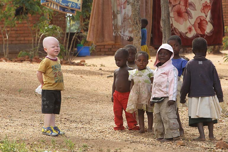 a year in pictures june-7-2016-african-albino-boy-with-his-friends